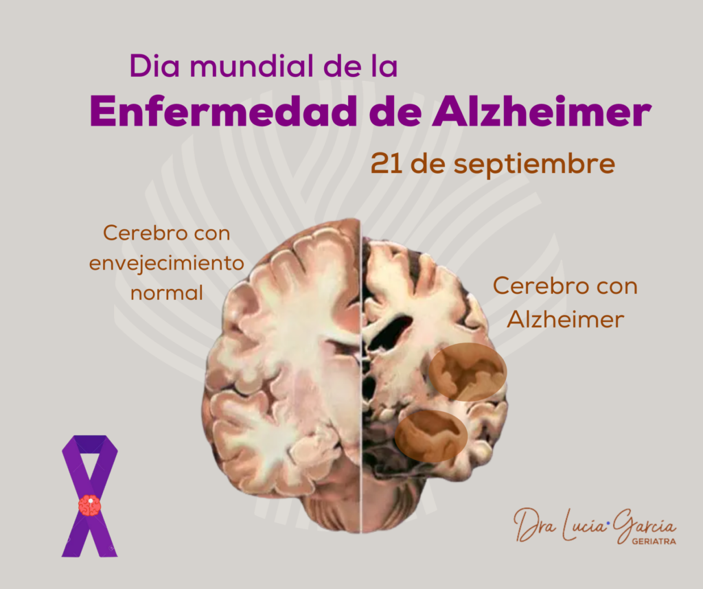 Enfermedad de Alzheimer