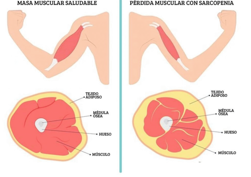 Sarcopenia: la pérdida de masa muscular en el adulto mayor
